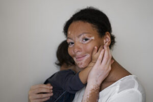 AUTOIMMUNE DISEASES